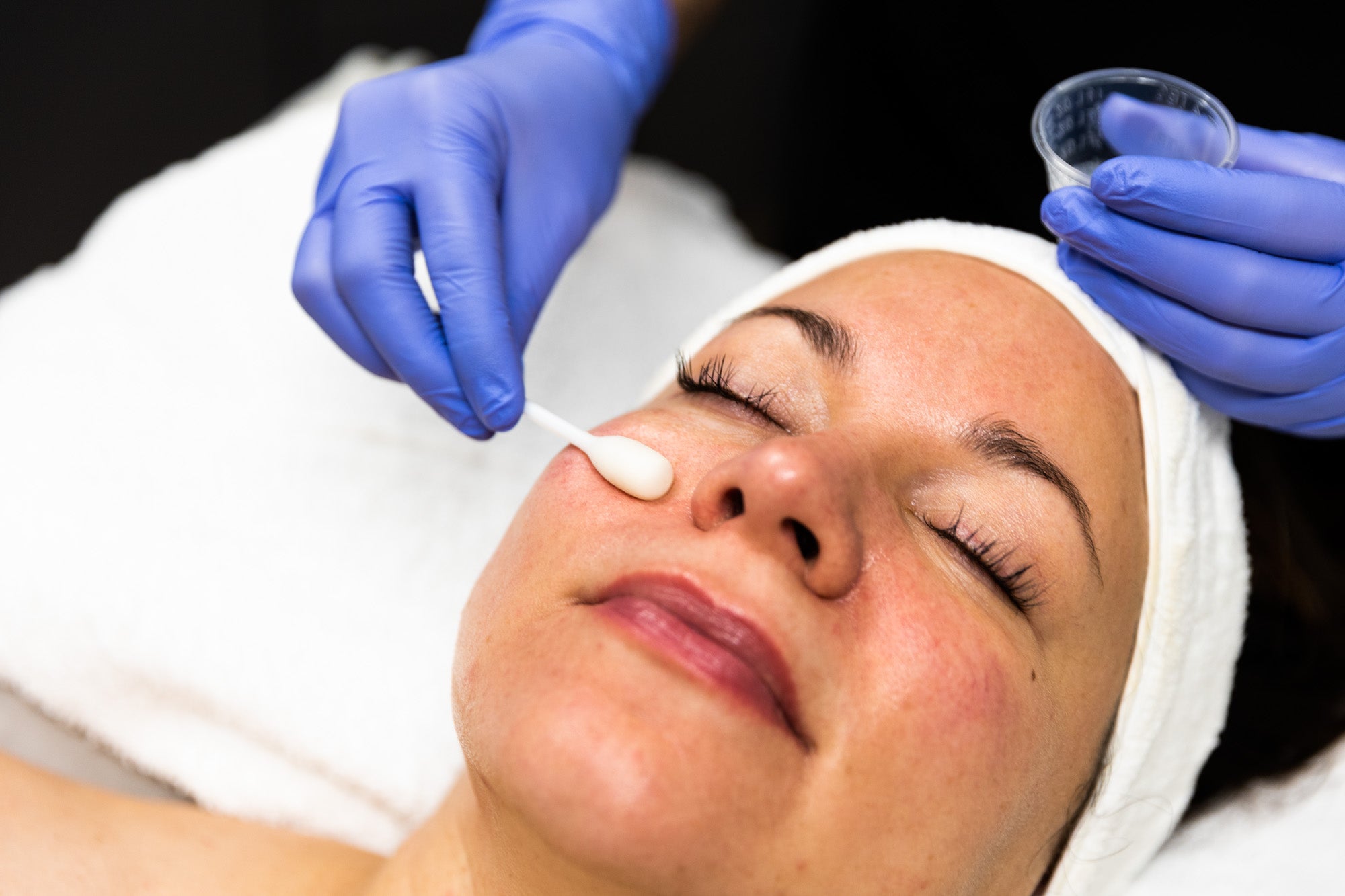 Jumbo Chemical Peel Swabs 100's - Image 3
