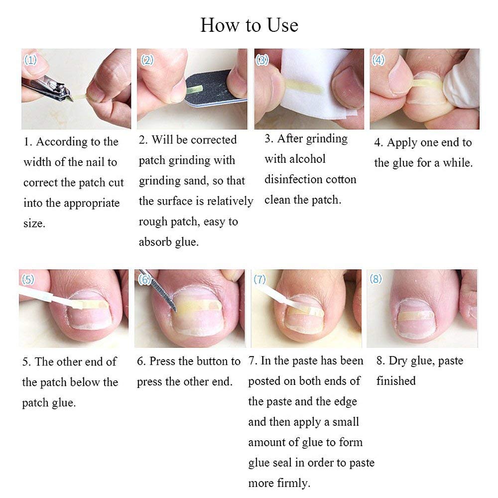 Alternative view of Ingrown toenail corrector strips