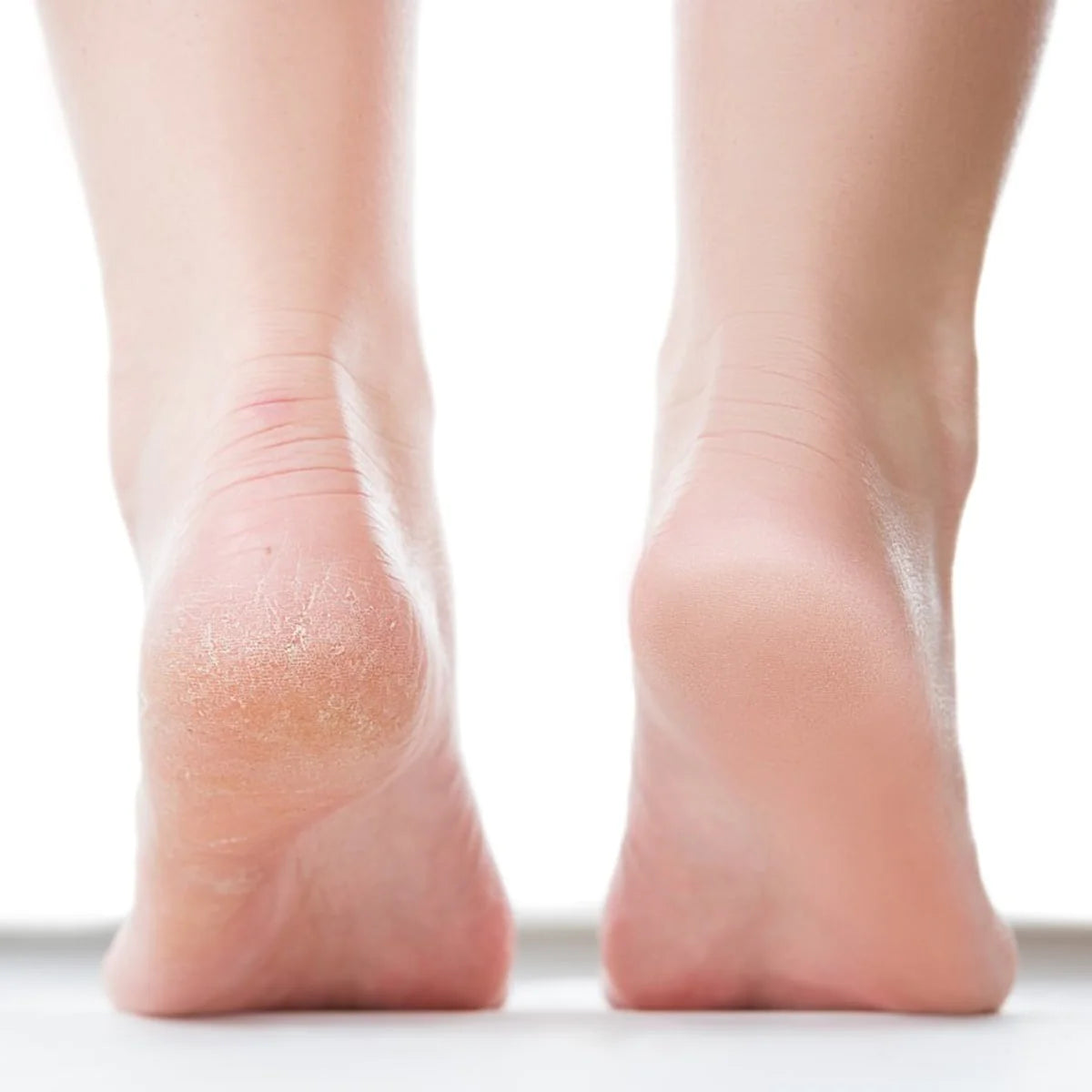 Heel Peel Course - One on One