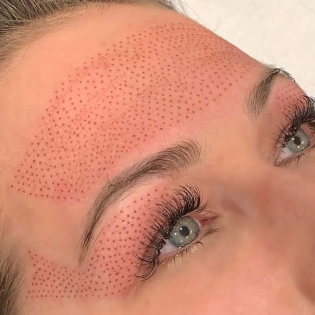 Plasma Skin Tightening Training | One-on-one